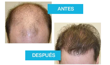 Profolan: antes y después de la recuperación capilar.