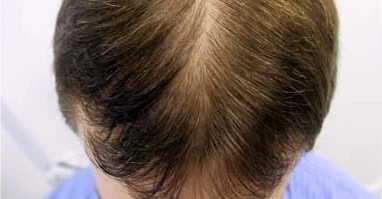 Primer mes con Profolan: inicio del crecimiento y reducción de la caída.